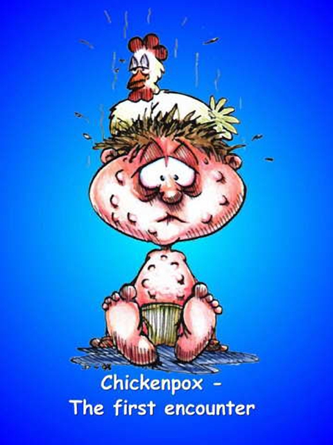 Chickenpox…